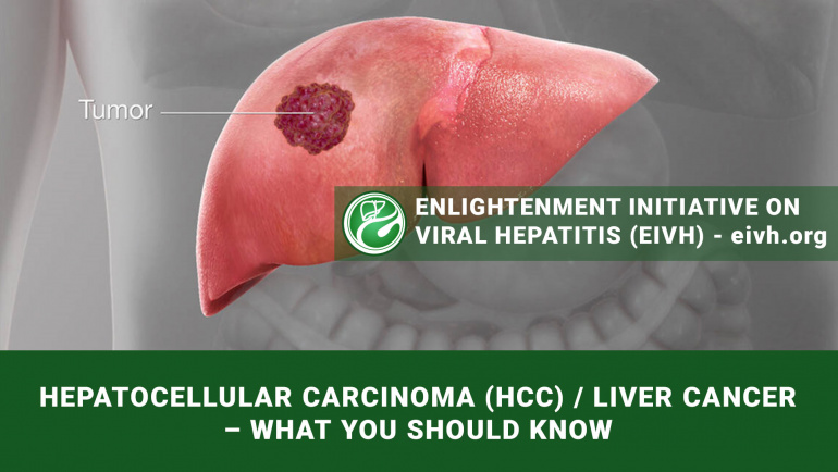 HEPATOCELLULAR CARCINOMA (HCC) / LIVER CANCER – WHAT YOU SHOULD KNOW